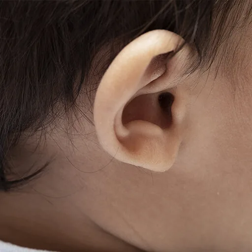 Protruding ears