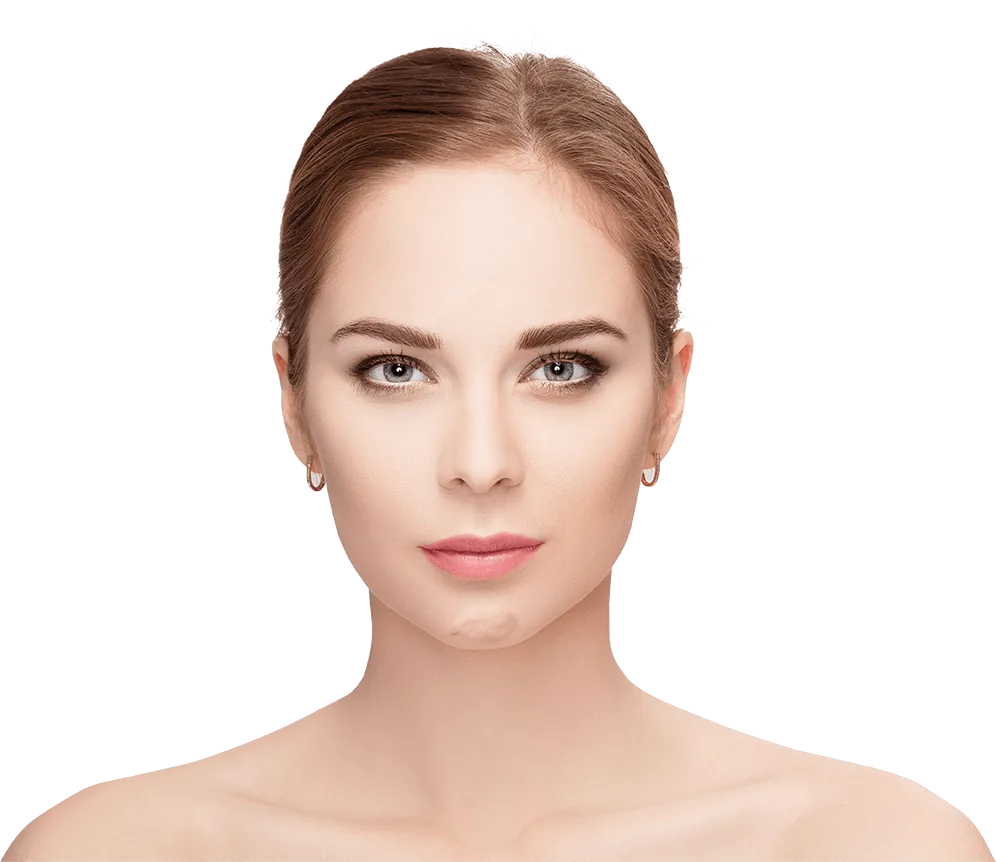 Chin crease