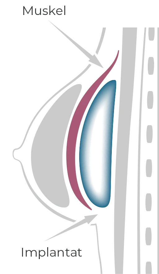 Implant behind the chest muscle