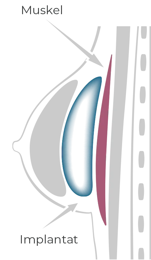 Implant in front of the chest muscle