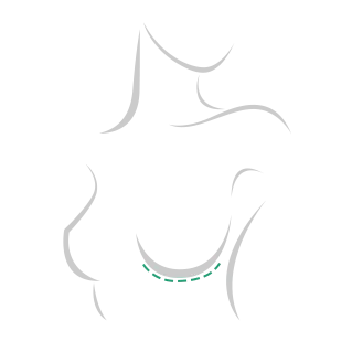 Incision in the inframammary fold