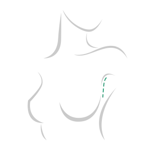 Incision in the armpit