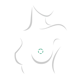 Incision at the areola