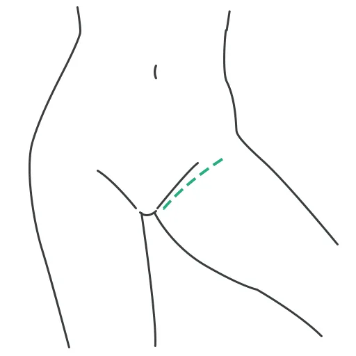 C-incision: incision in the groin area