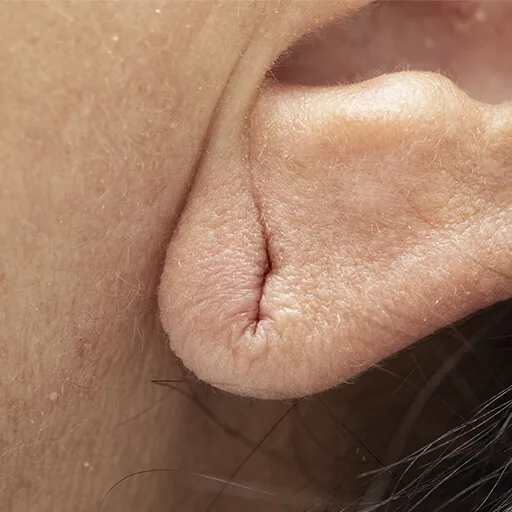 Torn earlobes
