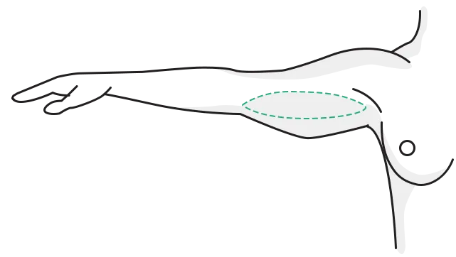 Incision on the inner upper arm