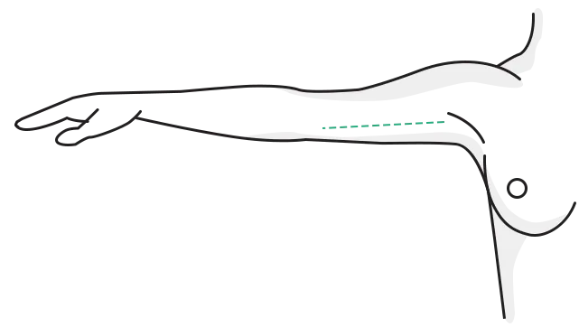Scar course after healing