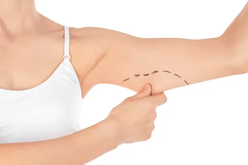 Firm upper arms after brachioplasty