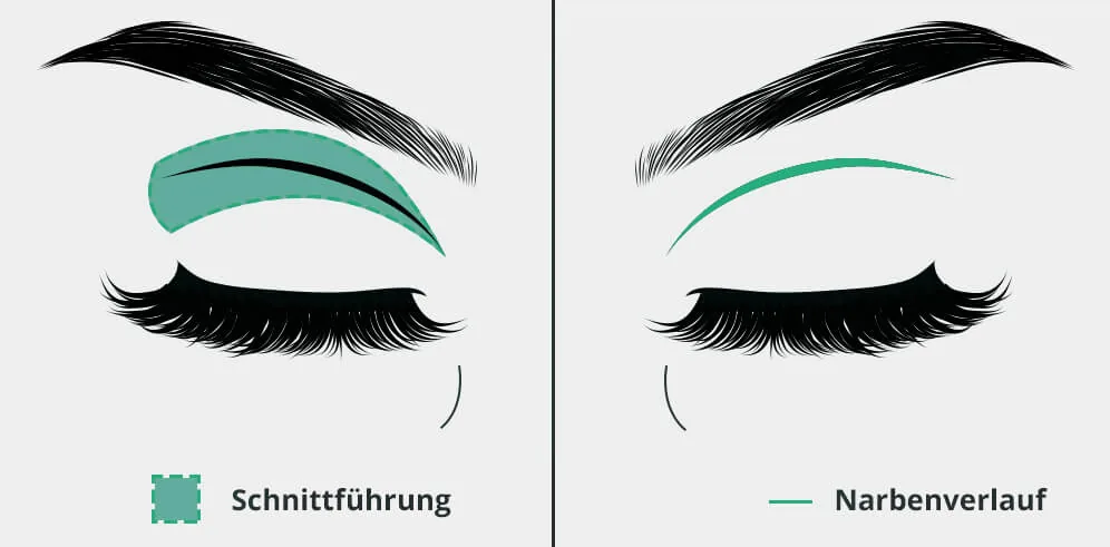 Incision in the natural eyelid crease and scar course