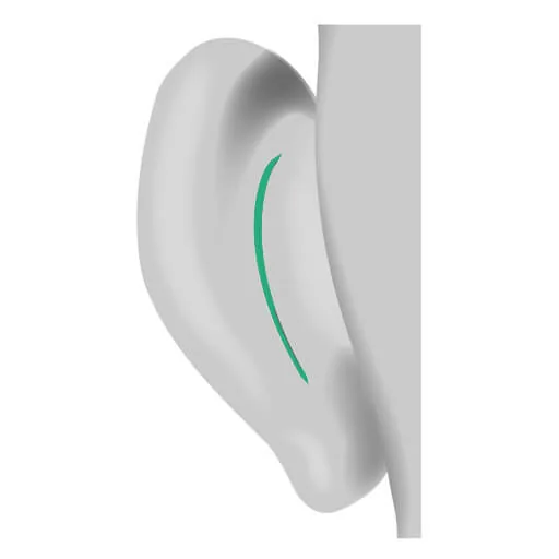1. Skin incision to expose the auricle