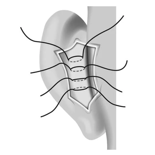 2. Exposing the auricle