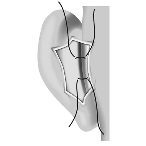 3. Thinning and modelling the cartilage