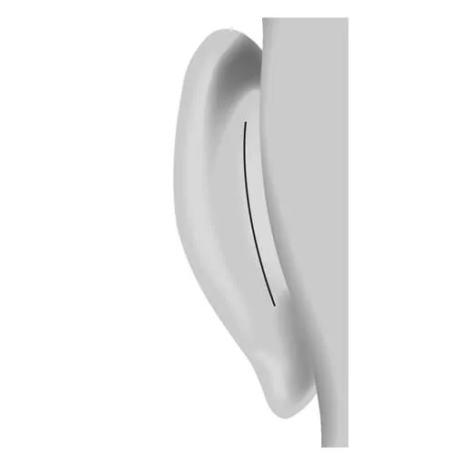 5. Fixed auricle