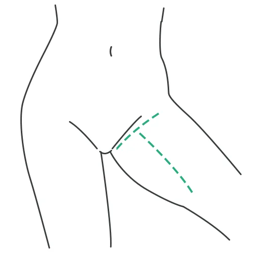T-incision: additional incision on the inner thigh